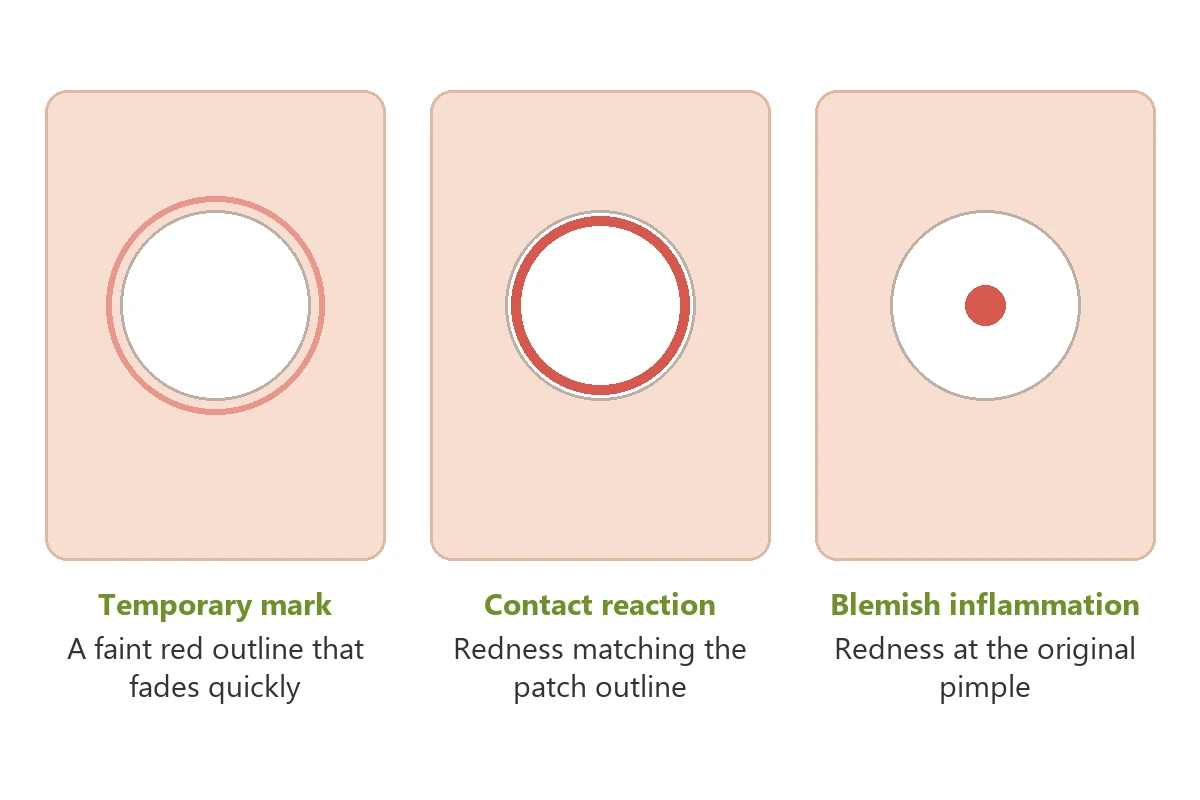 Pimple patch irritation showing possible redness around the adhesive area